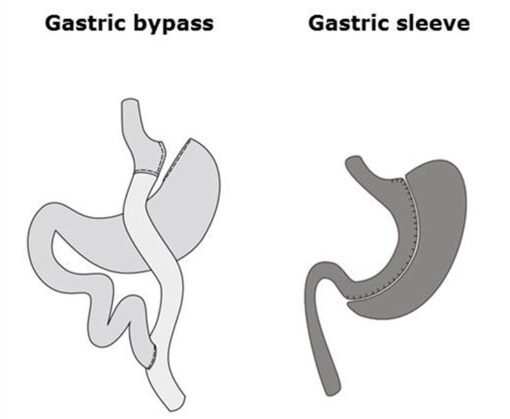Billede af gastric bypass og gastric sleeve.